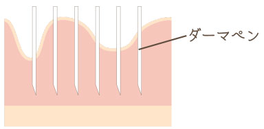 ダーマペン4の仕組み