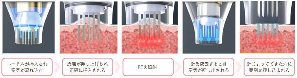 真皮層まで薬剤をしっかり届ける『ドラッグデリバリーシステム』