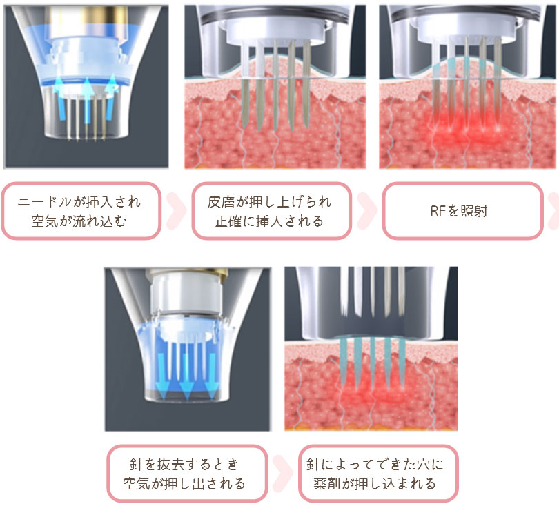 真皮層まで薬剤をしっかり届ける『ドラッグデリバリーシステム』