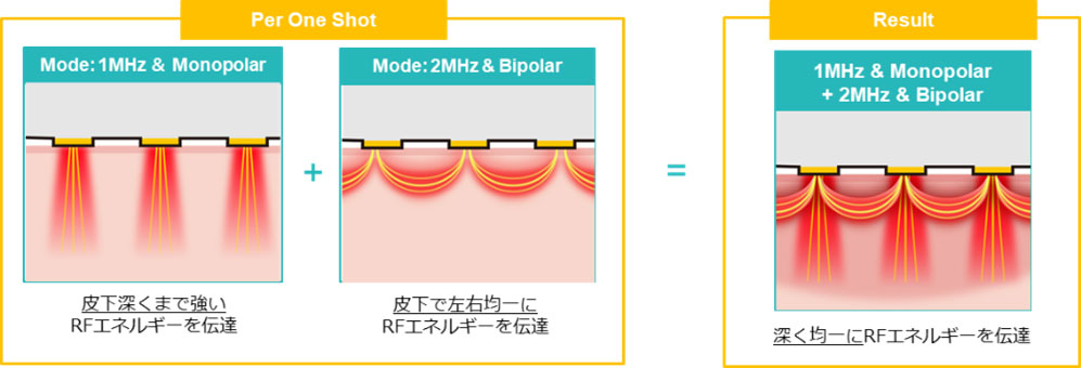 2種のRFを照射してたるみを引き締め