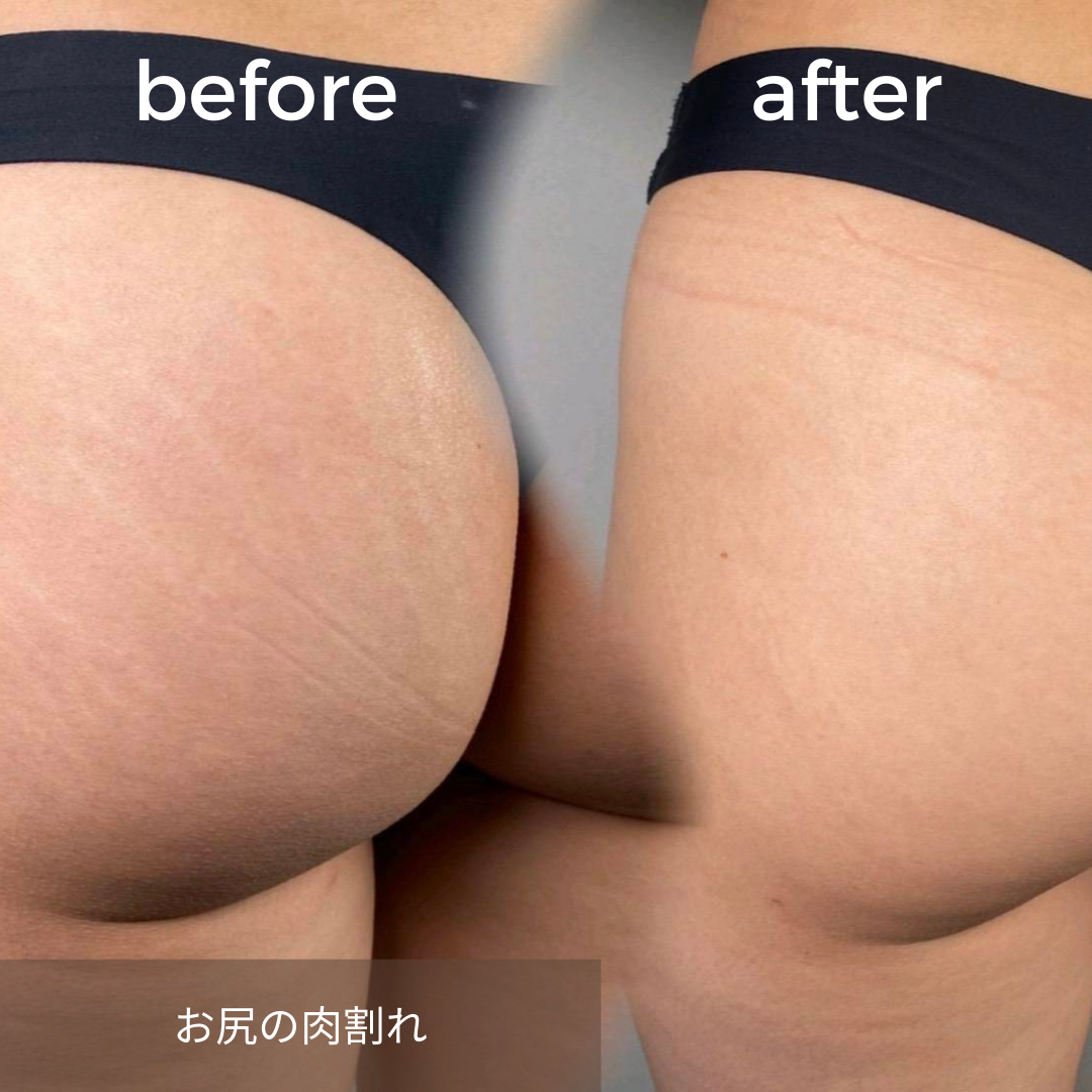 傷跡修正 Skin52 広島のメスを使わない美容のハンス美容クリニック 傷跡修正 Skin52 広島のメスを使わない美容のハンス美容クリニック
